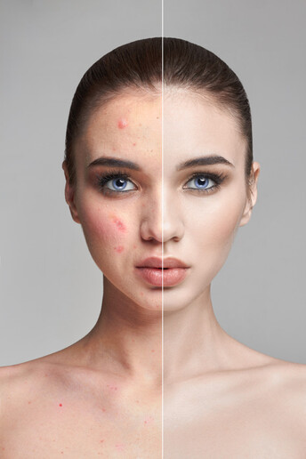 Acne Before And After